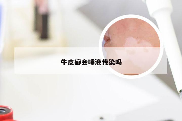 牛皮癣会唾液传染吗