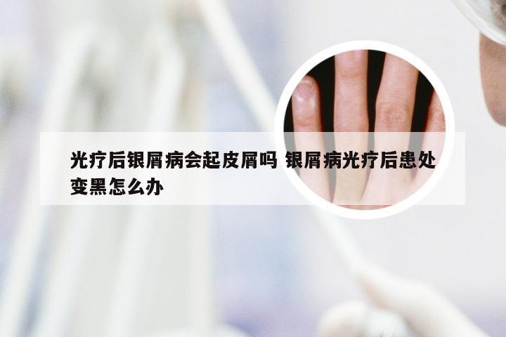 光疗后银屑病会起皮屑吗 银屑病光疗后患处变黑怎么办