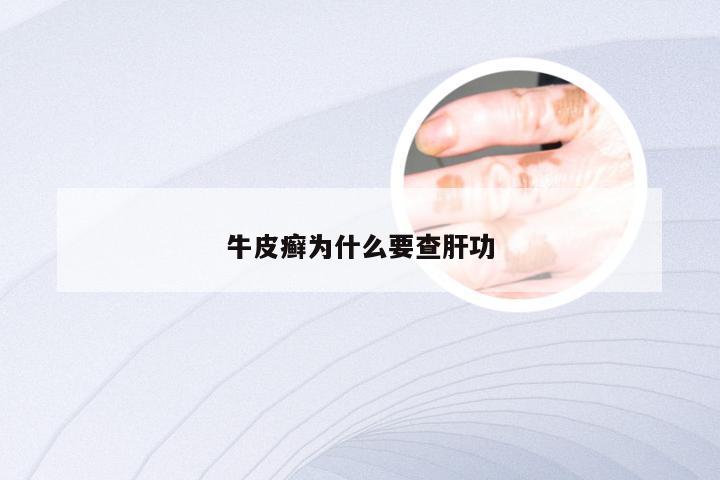 牛皮癣为什么要查肝功