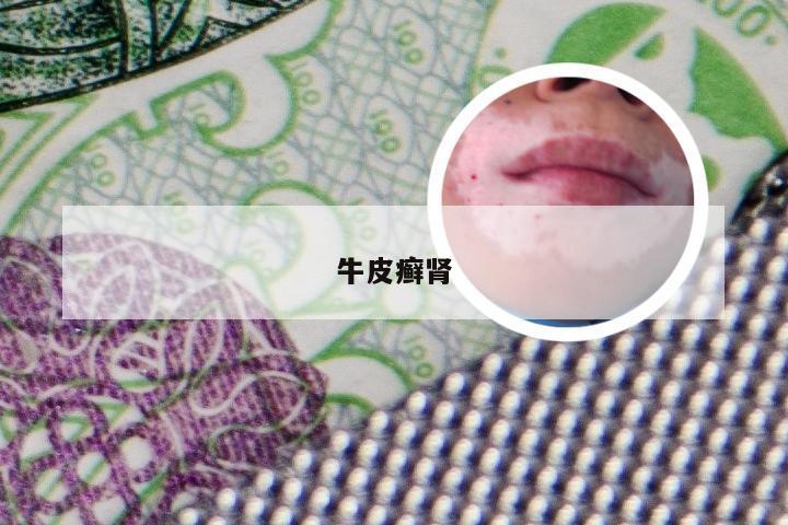牛皮癣肾