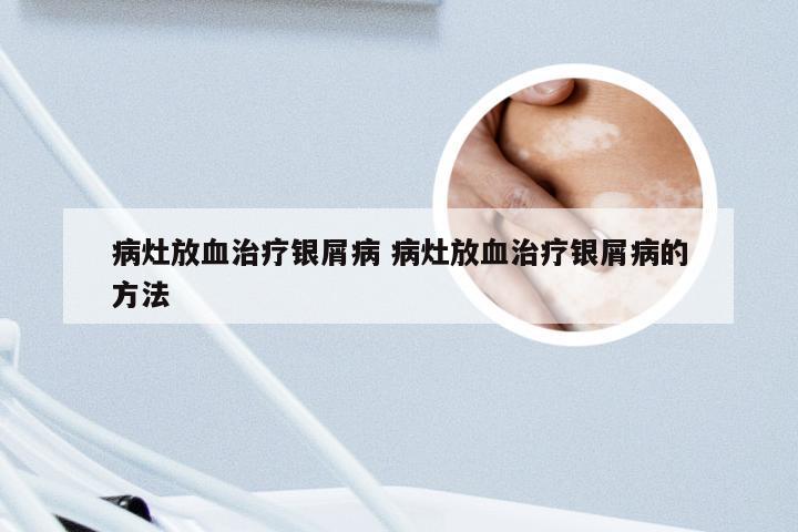 病灶放血治疗银屑病 病灶放血治疗银屑病的方法