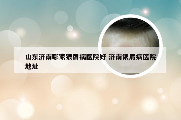 山东济南哪家银屑病医院好 济南银屑病医院地址
