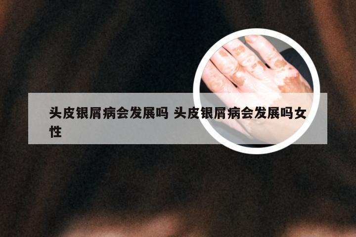 头皮银屑病会发展吗 头皮银屑病会发展吗女性