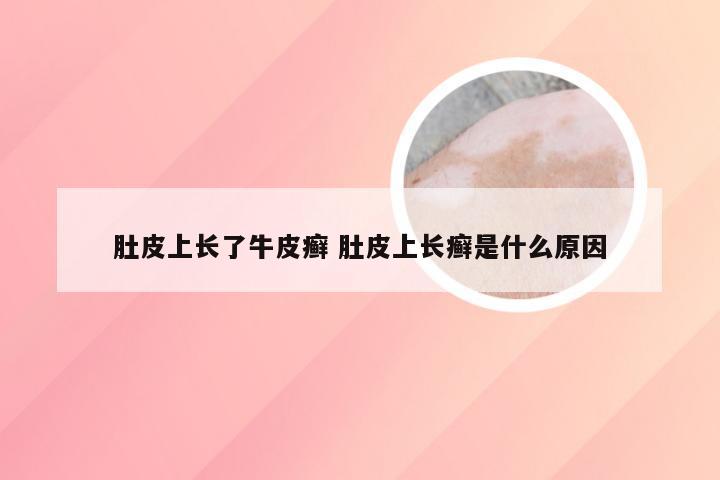 肚皮上长了牛皮癣 肚皮上长癣是什么原因