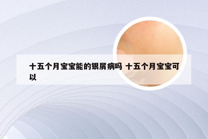 十五个月宝宝能的银屑病吗 十五个月宝宝可以