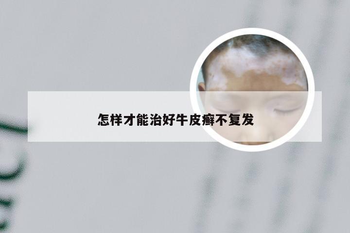 怎样才能治好牛皮癣不复发
