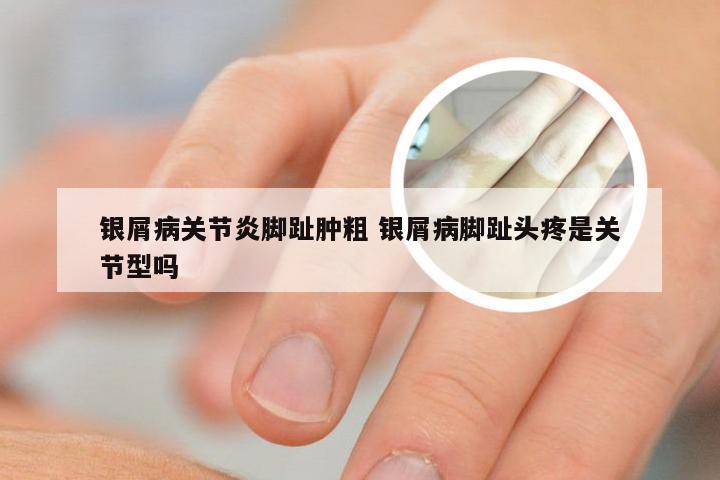银屑病关节炎脚趾肿粗 银屑病脚趾头疼是关节型吗