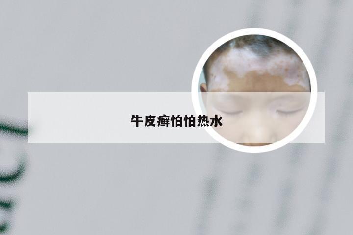 牛皮癣怕怕热水
