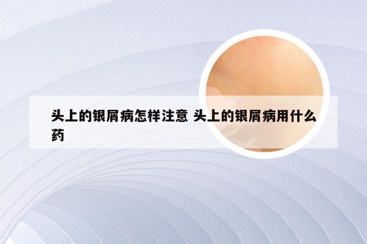 头上的银屑病怎样注意 头上的银屑病用什么药