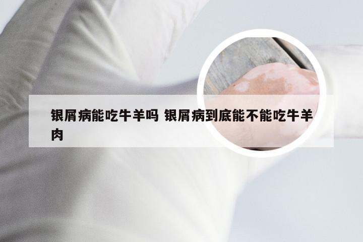 银屑病能吃牛羊吗 银屑病到底能不能吃牛羊肉