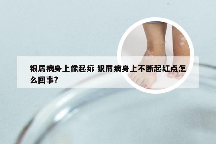 银屑病身上像起痱 银屑病身上不断起红点怎么回事?