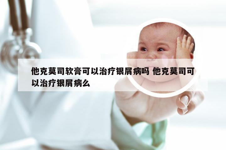 他克莫司软膏可以治疗银屑病吗 他克莫司可以治疗银屑病么