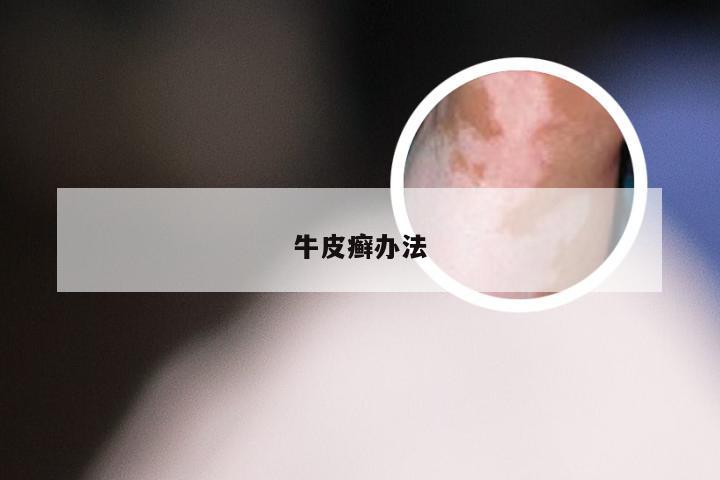牛皮癣办法