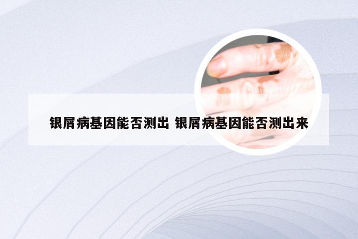 银屑病基因能否测出 银屑病基因能否测出来