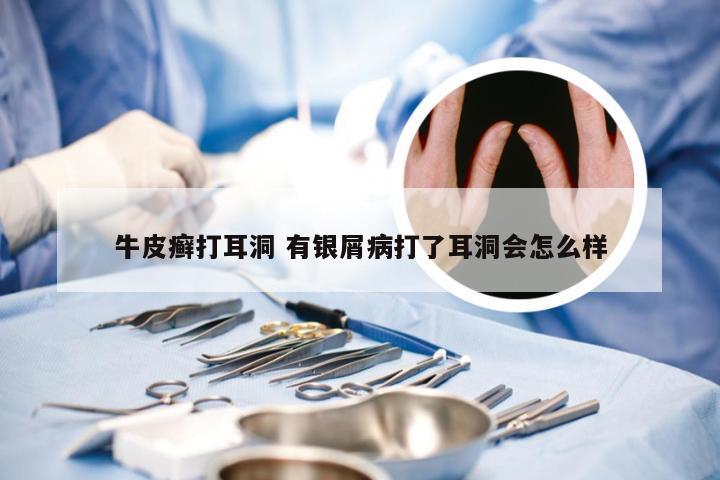 牛皮癣打耳洞 有银屑病打了耳洞会怎么样
