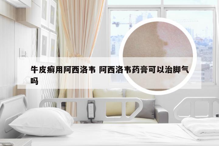 牛皮癣用阿西洛韦 阿西洛韦药膏可以治脚气吗