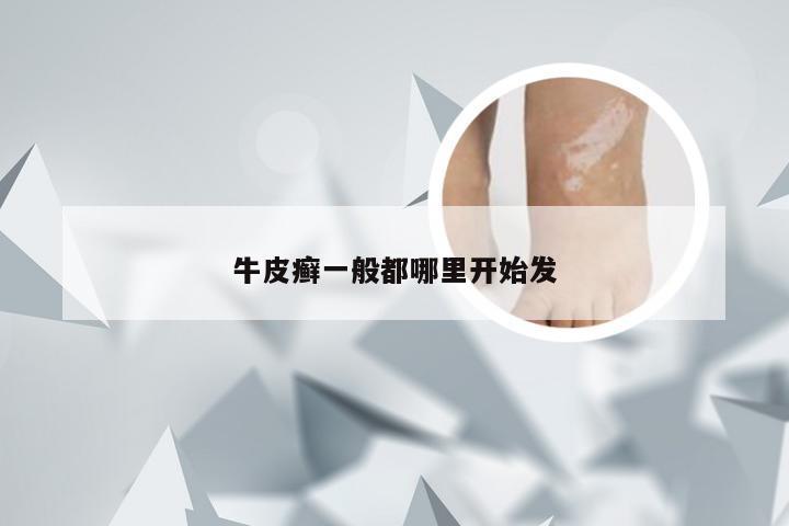 牛皮癣一般都哪里开始发