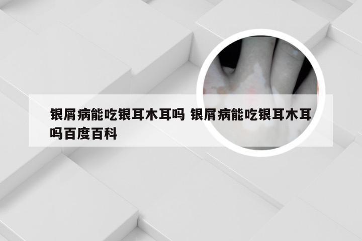 银屑病能吃银耳木耳吗 银屑病能吃银耳木耳吗百度百科