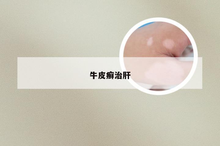 牛皮癣治肝