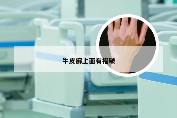 牛皮癣上面有褶皱