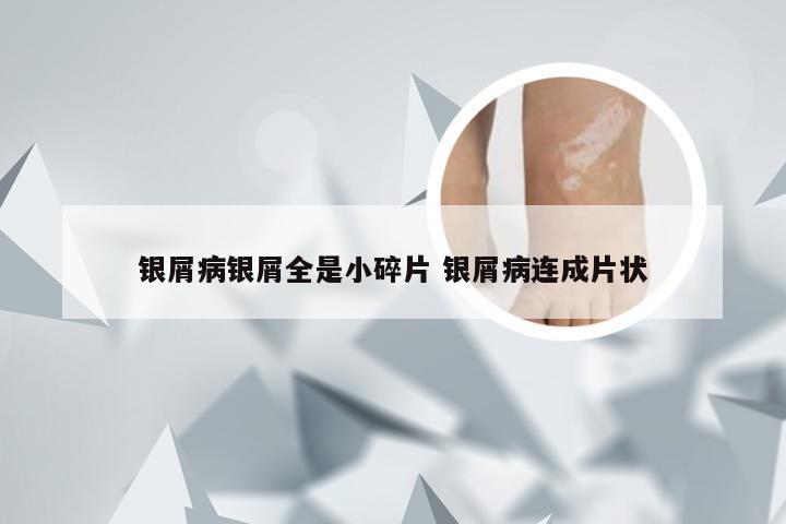 银屑病银屑全是小碎片 银屑病连成片状