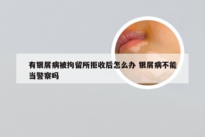 有银屑病被拘留所拒收后怎么办 银屑病不能当警察吗