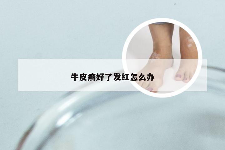 牛皮癣好了发红怎么办