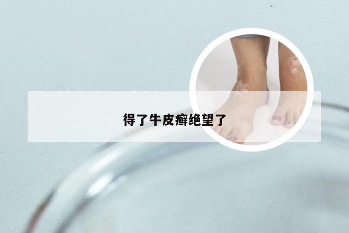 得了牛皮癣绝望了