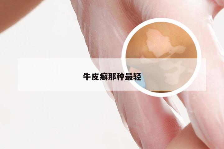 牛皮癣那种最轻