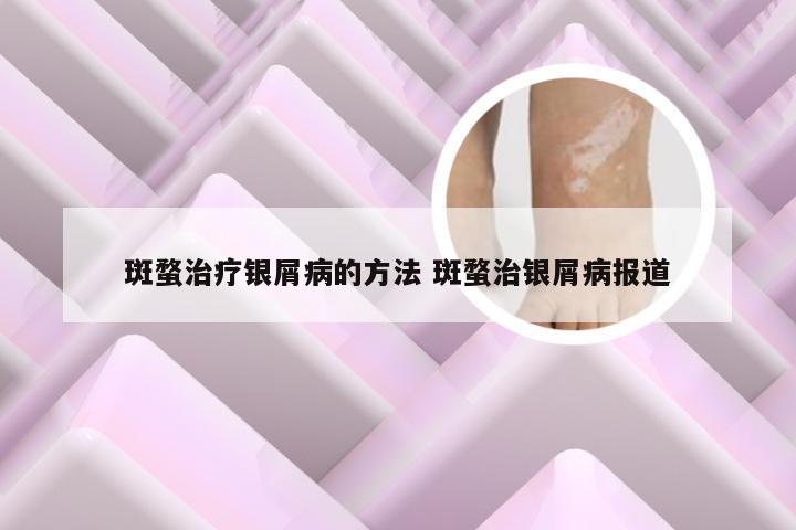 斑蝥治疗银屑病的方法 斑蝥治银屑病报道