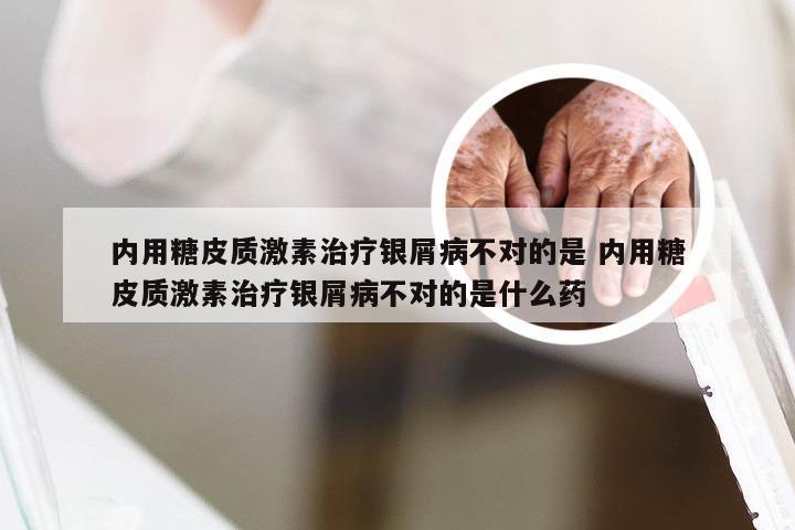 内用糖皮质激素治疗银屑病不对的是 内用糖皮质激素治疗银屑病不对的是什么药