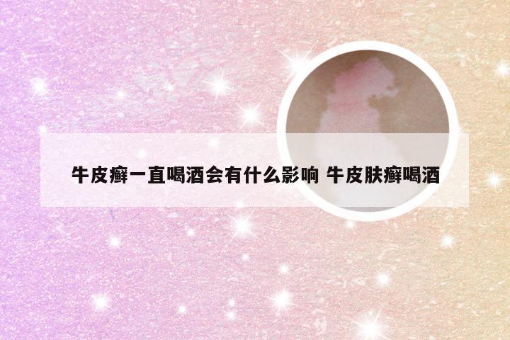 牛皮癣一直喝酒会有什么影响 牛皮肤癣喝酒