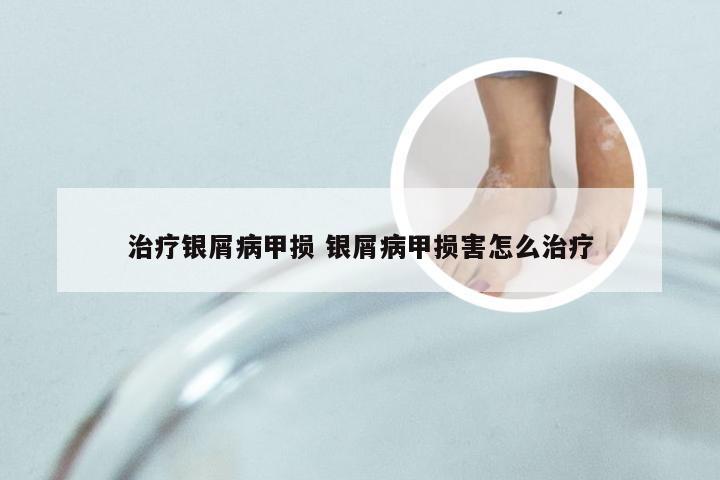 治疗银屑病甲损 银屑病甲损害怎么治疗