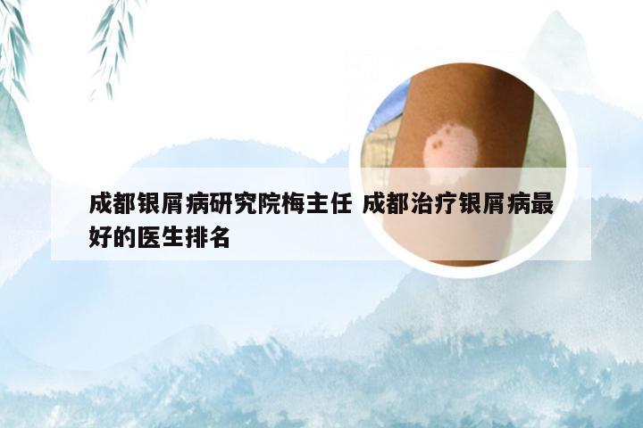 成都银屑病研究院梅主任 成都治疗银屑病最好的医生排名