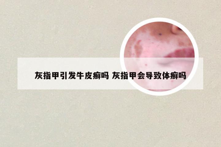 灰指甲引发牛皮癣吗 灰指甲会导致体癣吗
