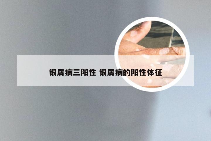 银屑病三阳性 银屑病的阳性体征