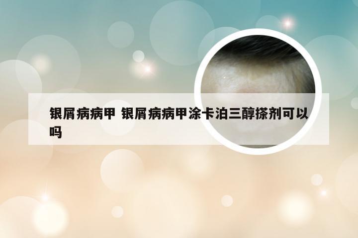 银屑病病甲 银屑病病甲涂卡泊三醇搽剂可以吗