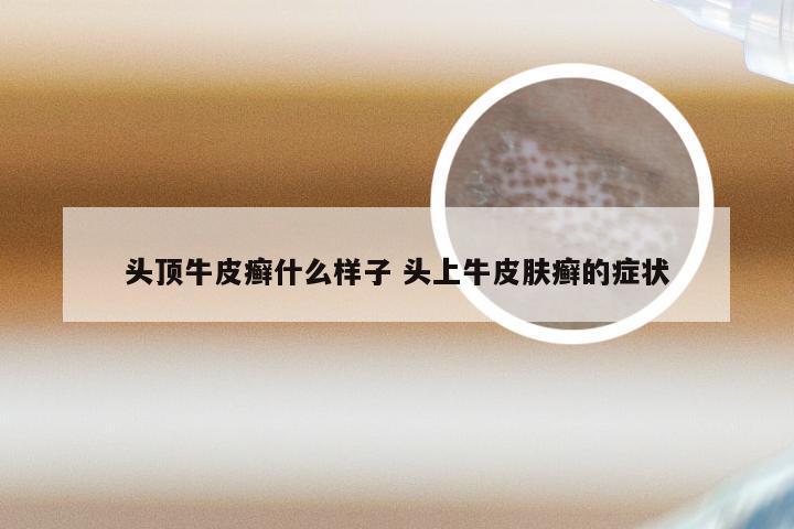 头顶牛皮癣什么样子 头上牛皮肤癣的症状