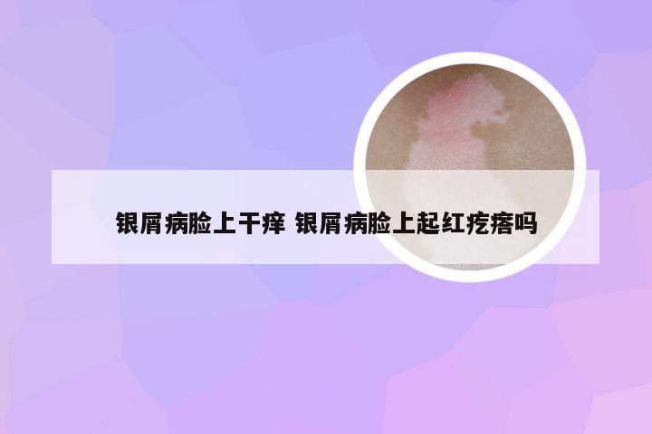银屑病脸上干痒 银屑病脸上起红疙瘩吗