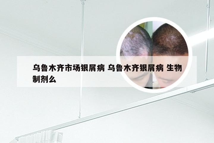 乌鲁木齐市场银屑病 乌鲁木齐银屑病 生物制剂么