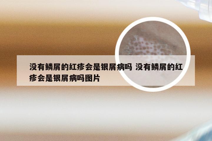 没有鳞屑的红疹会是银屑病吗 没有鳞屑的红疹会是银屑病吗图片