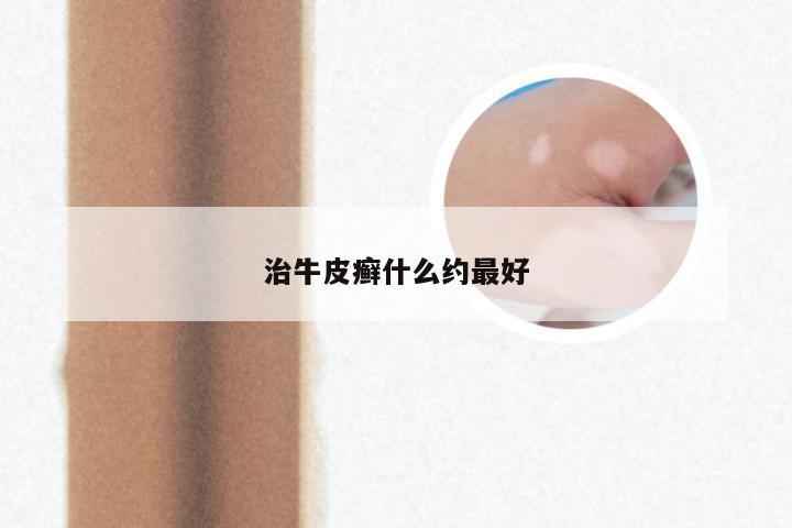 治牛皮癣什么约最好