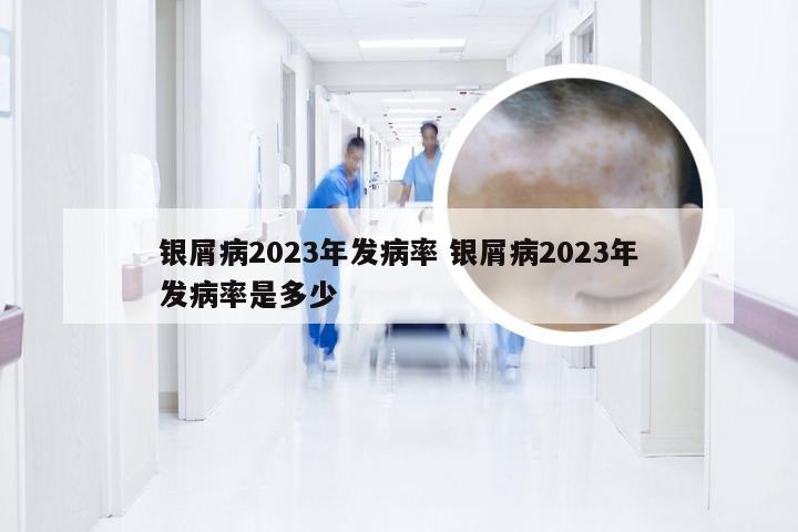 银屑病2023年发病率 银屑病2023年发病率是多少