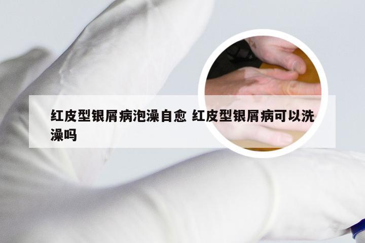 红皮型银屑病泡澡自愈 红皮型银屑病可以洗澡吗