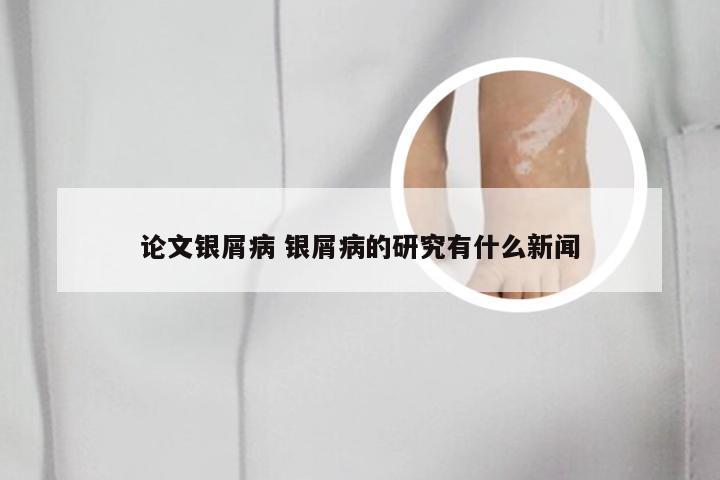 论文银屑病 银屑病的研究有什么新闻