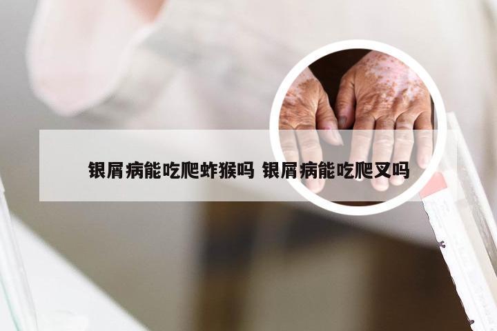 银屑病能吃爬蚱猴吗 银屑病能吃爬叉吗