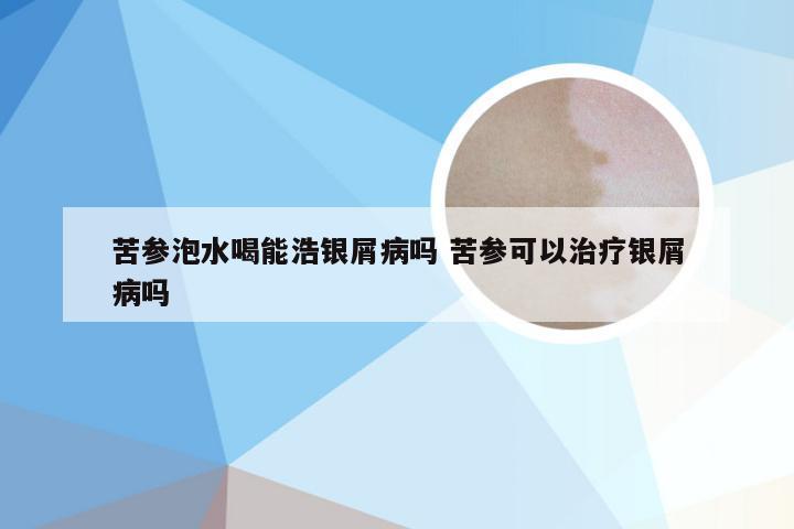 苦参泡水喝能浩银屑病吗 苦参可以治疗银屑病吗