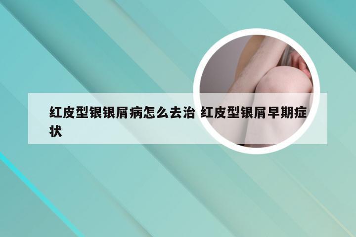 红皮型银银屑病怎么去治 红皮型银屑早期症状