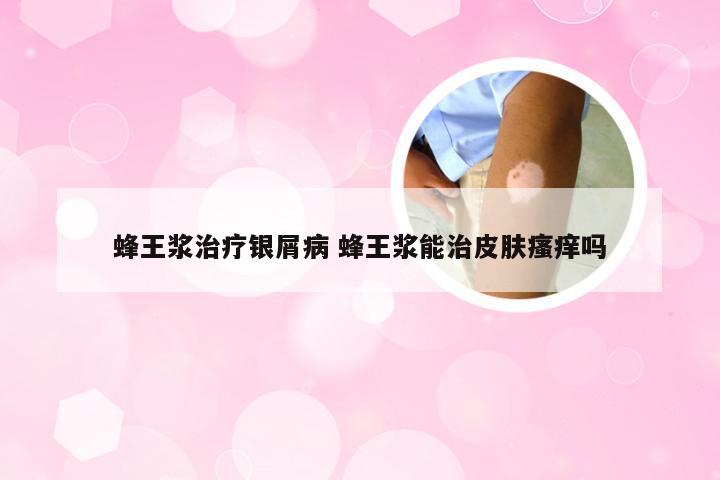 蜂王浆治疗银屑病 蜂王浆能治皮肤瘙痒吗