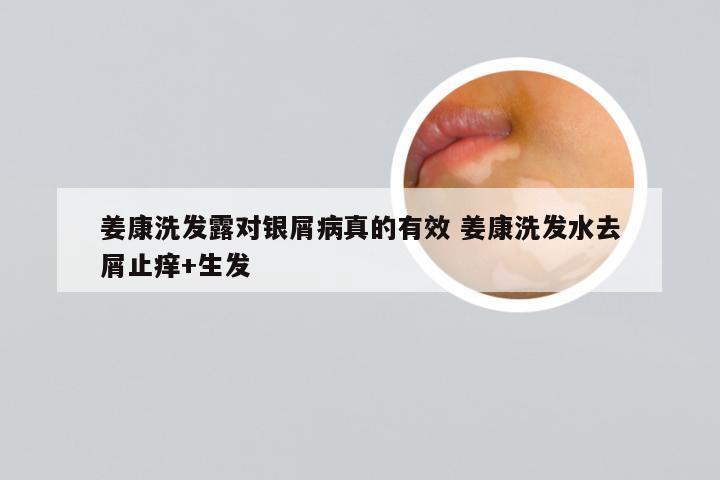 姜康洗发露对银屑病真的有效 姜康洗发水去屑止痒+生发